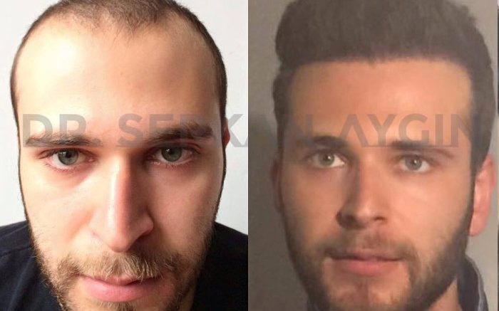 Tecnica contro le Stempiature - La Clinica in Turchia che Effettua Trapianti Sicuri.
